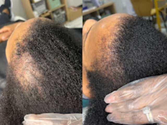 NHCG Trichology - Hair Restoration & Head Spa, head spa in Katy, TX